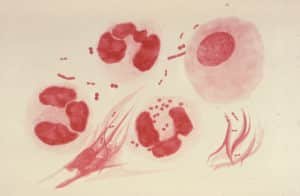 How the Throat Becomes a "Silent Vessel" for Gonorrhoea Image