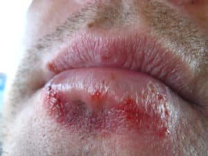 Oral STDs: All That You Need To Know Image