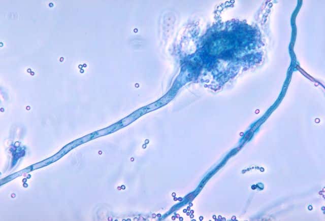 All What You Need to Know About Trichomoniasis Image