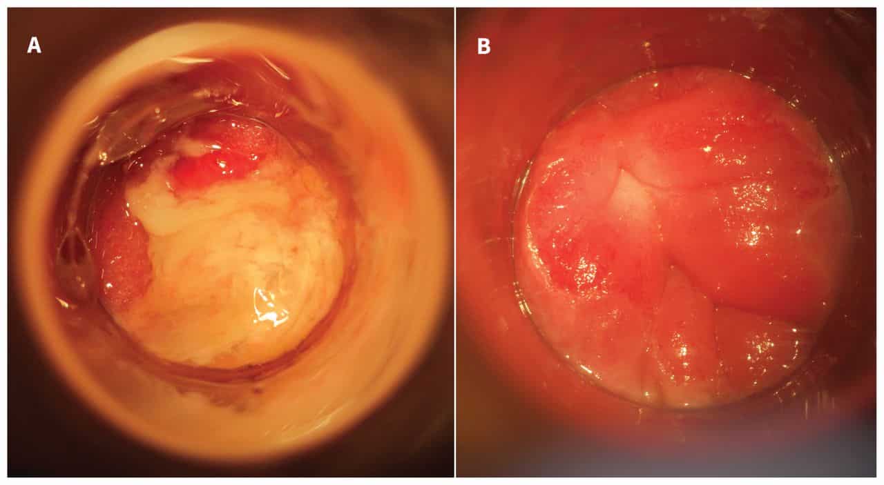 Lymphogranuloma Venereum Proctocolitis (LVG) in Africa Image