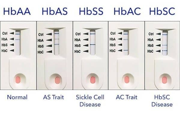 Sickle Cell Test Kits - Image 2